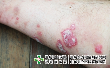 攝圖網_323551459_絲蟲病宏觀藥品疾病彎頭發癢病人醫療皮膚手臂皮炎(企業商用) 攝圖網_323551459_絲蟲病宏觀藥品疾病彎頭發癢病人醫療皮膚手臂皮炎(企業商用)