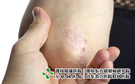 攝圖網(wǎng)_502556199_手肘上的絲蟲(企業(yè)商用) 攝圖網(wǎng)_502556199_手肘上的絲蟲(企業(yè)商用)