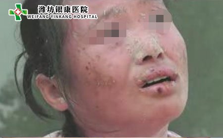 濰坊牛皮癬醫院:中藥治療牛皮癬