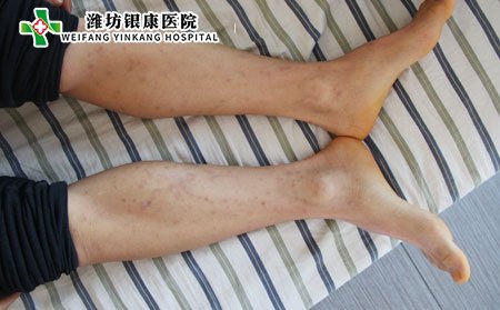 濰坊牛皮癬醫(yī)院:牛皮癬遺傳怎么辦?